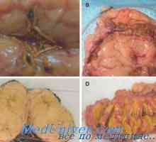 Hiperaldosteronism primar (boala Conn) morfologie, anatomie patologică