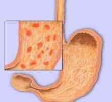 Primele semne si simptome de gastrită stomac