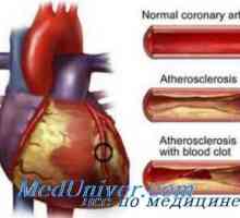 Pituitrin și insuficiență coronariană. necroză miocardică sub acțiunea vasopresinei