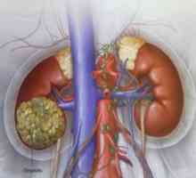 Carcinom cu celule renale: tratament, simptome, cauze, simptome