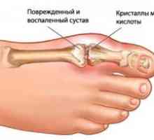 Artrita gutoasă a articulațiilor: tratament, simptome, semne, cauze