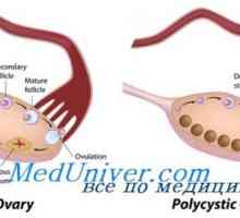 Ovare polichistice. Sindromul mat - Leventhal