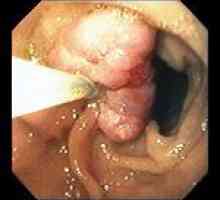 Polipii 12 ulcer duodenal
