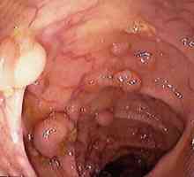 Polipii pancreasului