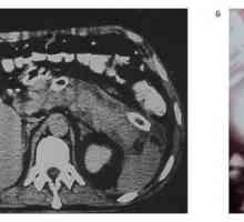 Helminților pancreas înfrângere: Clonorchiasis, fascioliasis