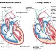 Defect cardiac tetralogie Fallot: tratament, prognostic, semne, simptome, cauze