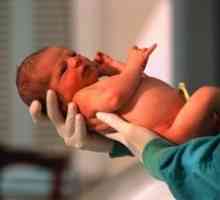 Malformații de nou-născuți