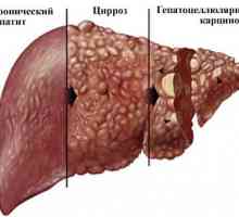 Consecințe opisthorchiasis la adulți, impactul asupra organismului uman