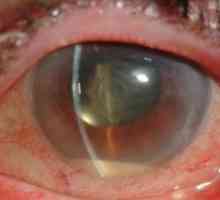 Ochii endoftalmită Postoperator