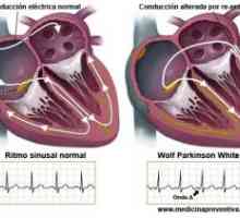 Insuficiență ventriculară dreaptă
