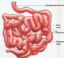 Cauzele diverticulozei intestinale la copii si adulti