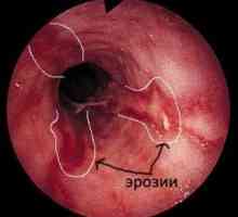 Cauze și forme de esofagitei erozive