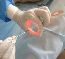 Cauterizare cu laser ulcer gastric ca metodă de tratament
