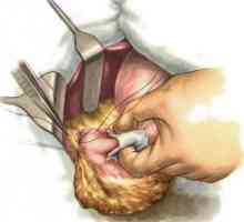 Ulcer gastric perforat sau perforație ulcer gastric, simptome și tratament