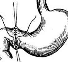 Perforate (perforate), ulcer duodenal