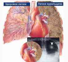 Bronhii si cancer pulmonar, tratament, simptome, cauze