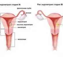 Cancer endometrial: simptome, etapa, tratament, diagnostic, prognostic, cauze, simptome, prevenirea