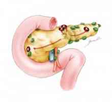 Metastazei cancerului pancreatic