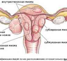 Cancer uterin: stadiu, simptome, tratament, diagnostic