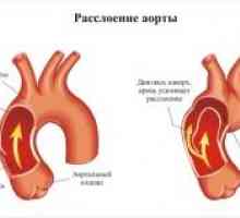 Disecție aortică: simptome, cauze, tratament, simptome, diagnostic