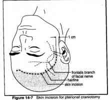 Inciziile (craniotomie pterional)