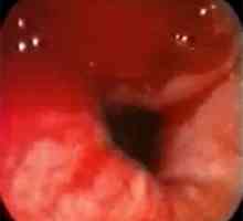 Ruptură a esofagului: Cauze, simptome, tratament