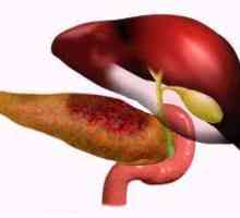 Pancreatită recurentă, forma acută sau cronică recurentă