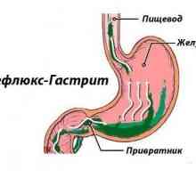 Gastrita de reflux: Semne, simptome și tratament