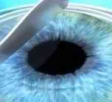 Chirurgia refractiva Ochi: Ce este?
