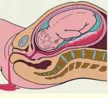 Sangerare rectala in timpul sarcinii