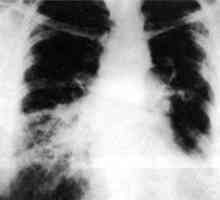 Rezultatele biopsiei pulmonare Thoracoscopic