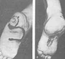 Scar deformare a piciorului si glezna. defecte de tratament de suprafață plantară a piciorului în…