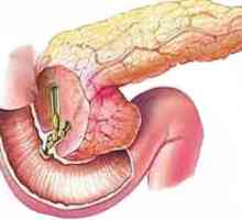 Pancreas Loose și denivelate