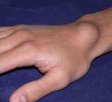 Sarcom de țesut pe zona de mână și încheietura mâinii: cauze, tratament