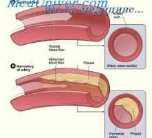 Hipercolesterolemie Familial. Factorii de risc pentru ateroscleroza
