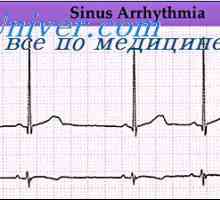 Aritmii cardiace. Violarea ritmului nodului sinusal