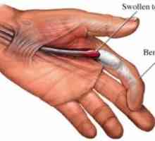 Trigger degetul: cauze, tratament, simptome, semne, prevenirea