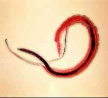 Schistosomiasis: simptome, tratament, diagnostic