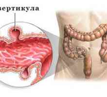 Simptomele și tratamentul diverticulozei de colon sigmoid