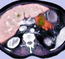 Simptomele de cancer pancreatic, cancer al capului și coada așa cum se manifestă?