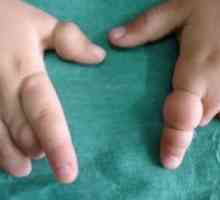 Sindromul gâtuiri amniotice: cauze, tratament