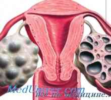 Sindromul ovarului polichistic. Sindromul Stein-Leventhal
