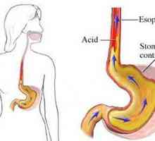 Sindromul de esofagita de reflux