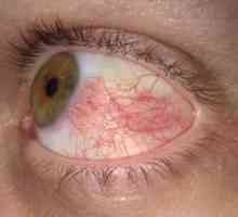 Sclerită ochi: tratament, simptome, cauze, simptome