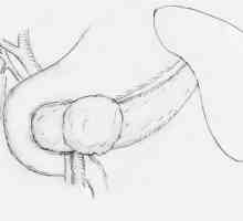 Tumoare Pseudopapillary-solid a pancreasului