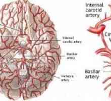 Boli vasculare ale creierului