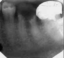 Metode Imbunatatirea zaapikalnoy tratamentului la pacientii cu forme distructive ale periodontitei.