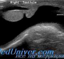 Spermatocel și hidrocel la copii. tumori testiculare