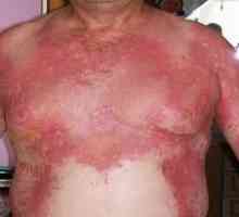 Sindromul stafilococică pielii opărite: tratament, cauze, simptome, semne