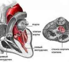 Stenoza aortica, gura, tratament, cauze, simptome, semne